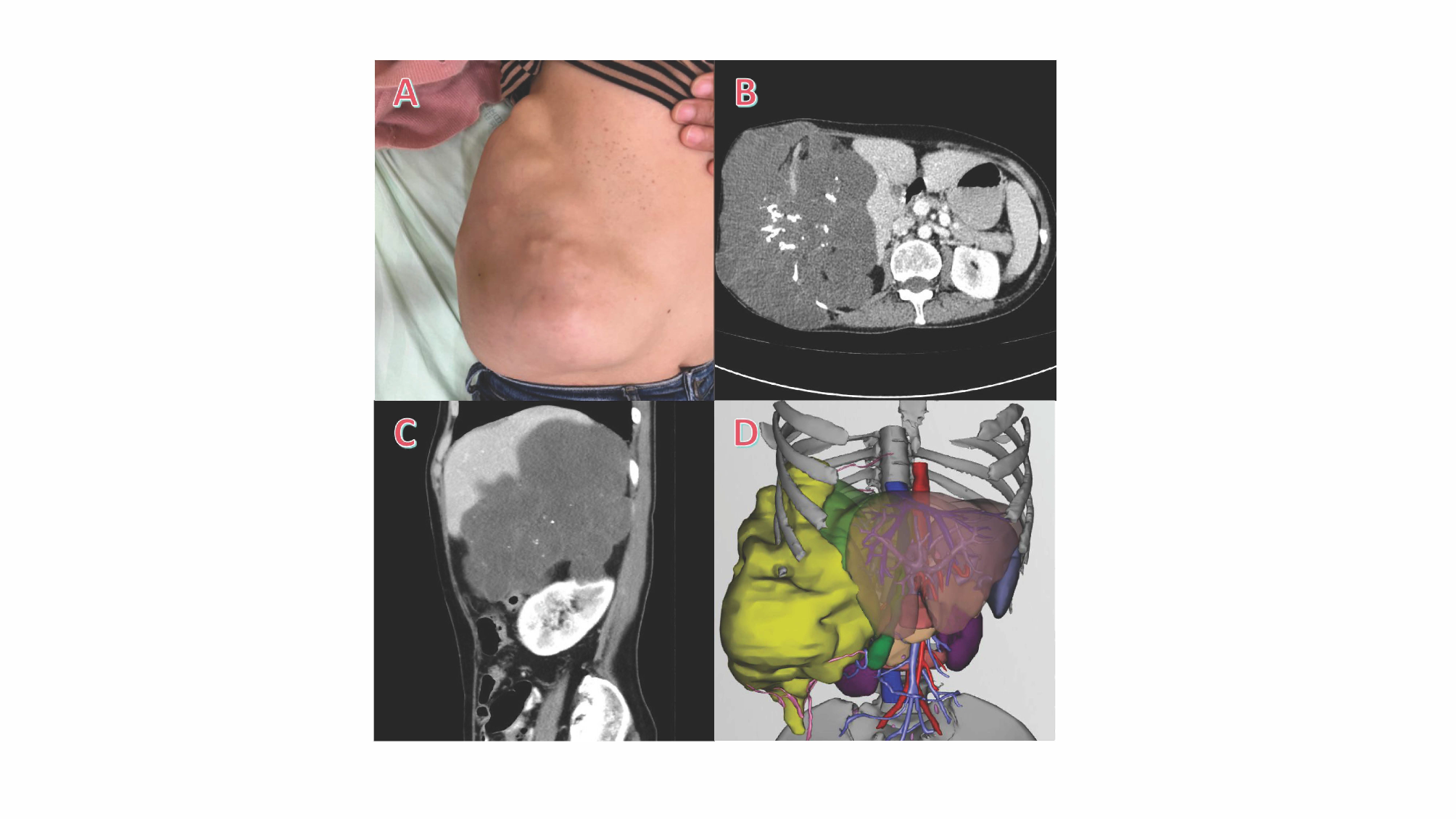 Complete resection of a giant costal chondrosarcoma with reconstruction of the thoraco-abdominal wall: a case report