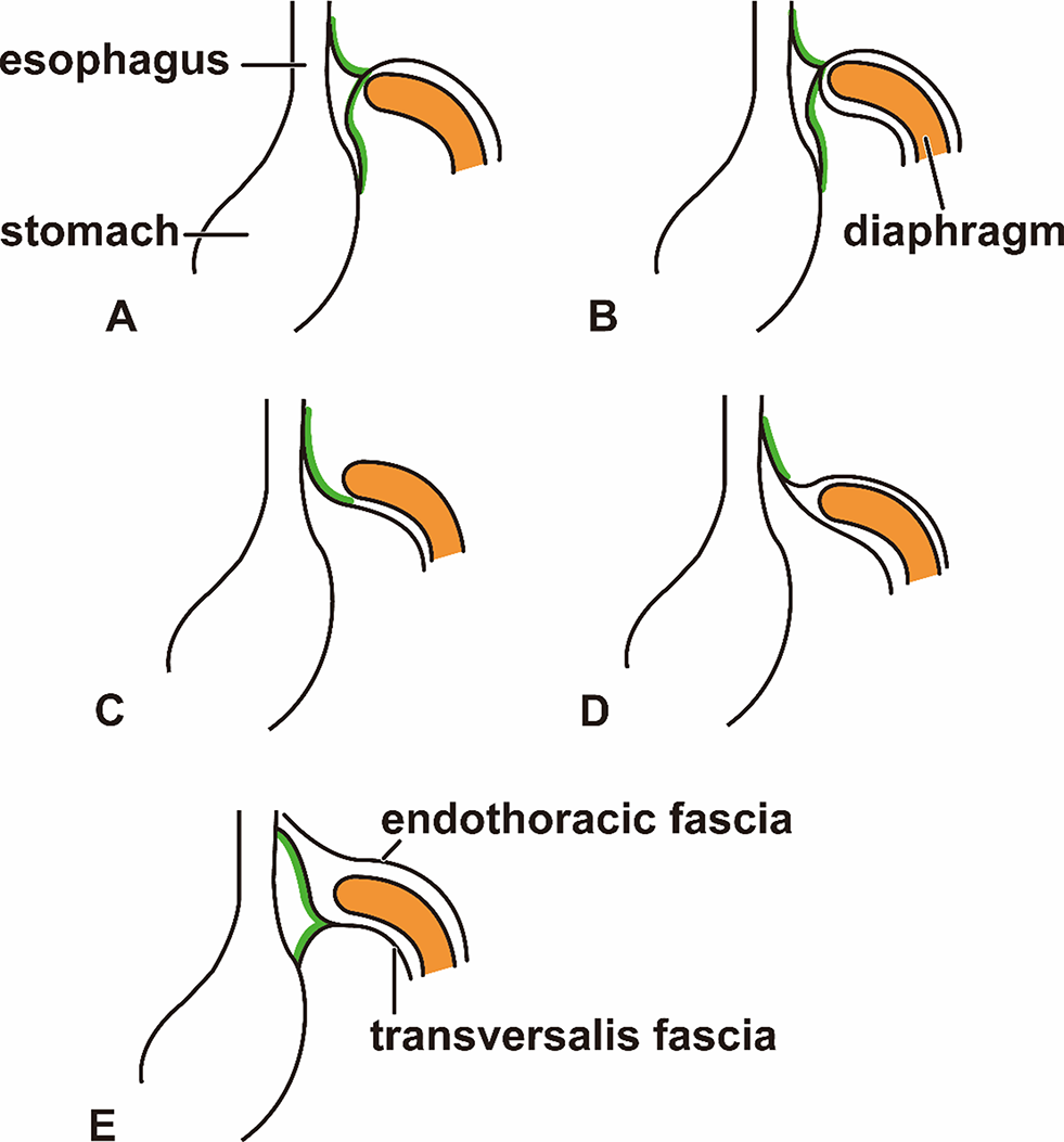 Development and growth of fasciae in and around the esophageal hiatus: a histological study using human fetuses