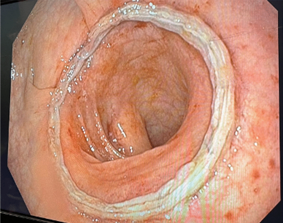 Perioperative assessment of colorectal anastomoses with flexible endoscopy