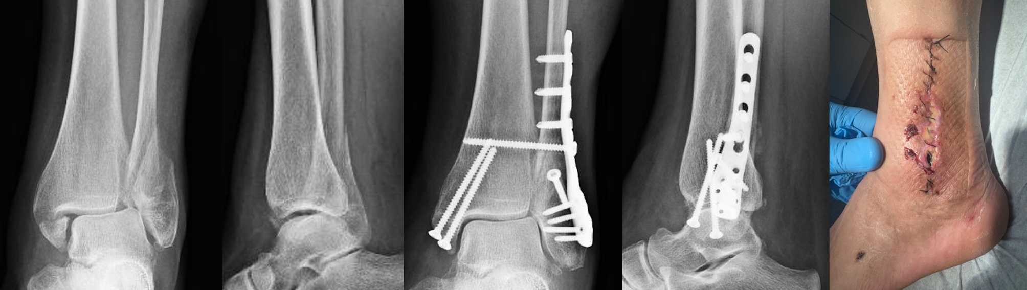 Modern anatomical locking plates are associated with increased postoperative wound complications and unplanned surgical revisions compared to standard tubular plates in the management of unstable ankle fractures: a comparative cohort study in 595 patients