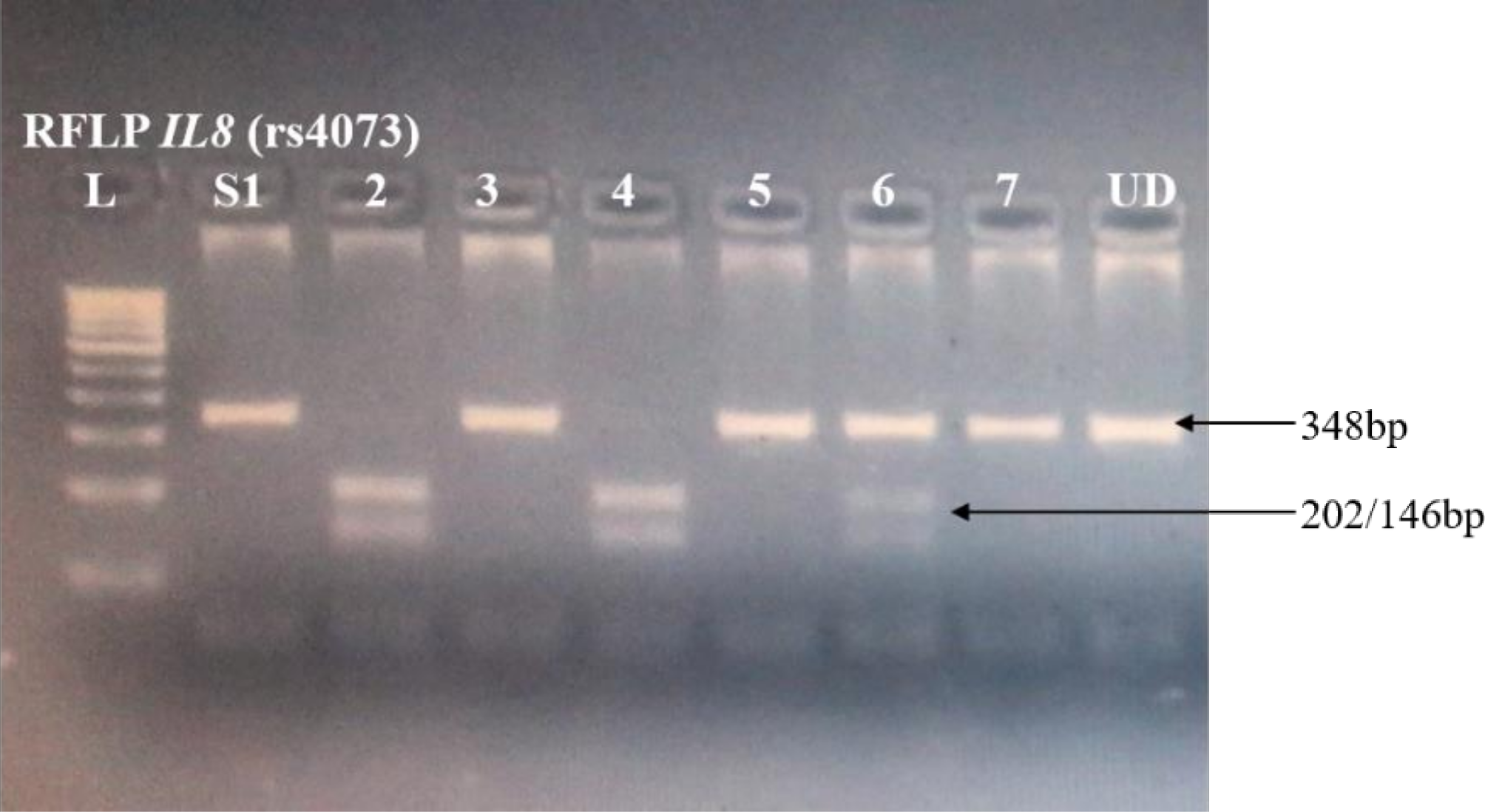 Suggestive evidence of male specific genetic association of IL8 -251T>A promoter polymorphism with primary angle closure glaucoma in a north Indian Punjabi population