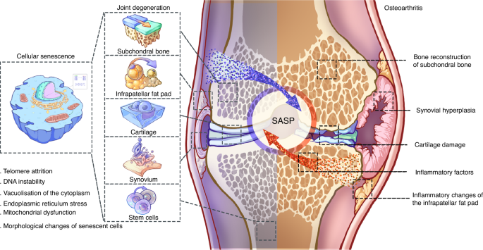 Cross-talk of inflammation and cellular senescence: a new insight into the occurrence and progression of osteoarthritis