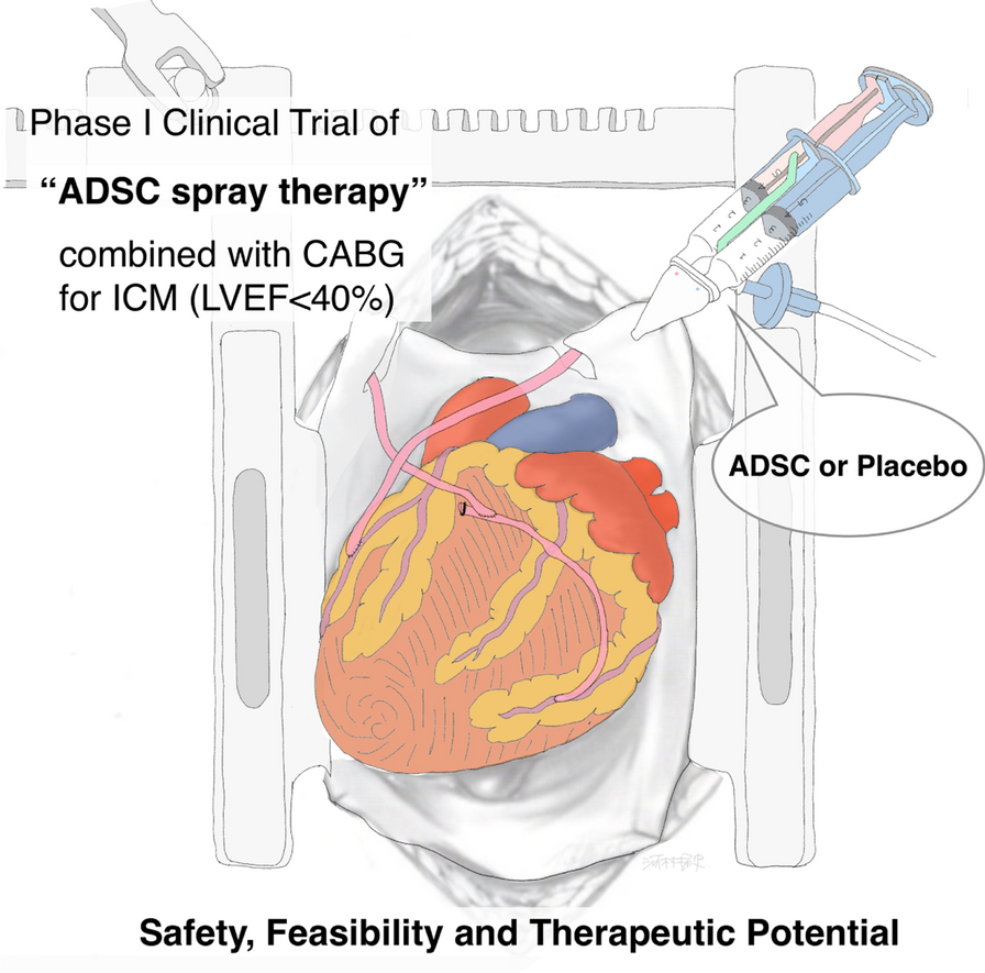 Safety and therapeutic potential of allogeneic adipose-derived stem cell spray transplantation in ischemic cardiomyopathy: a phase I clinical trial