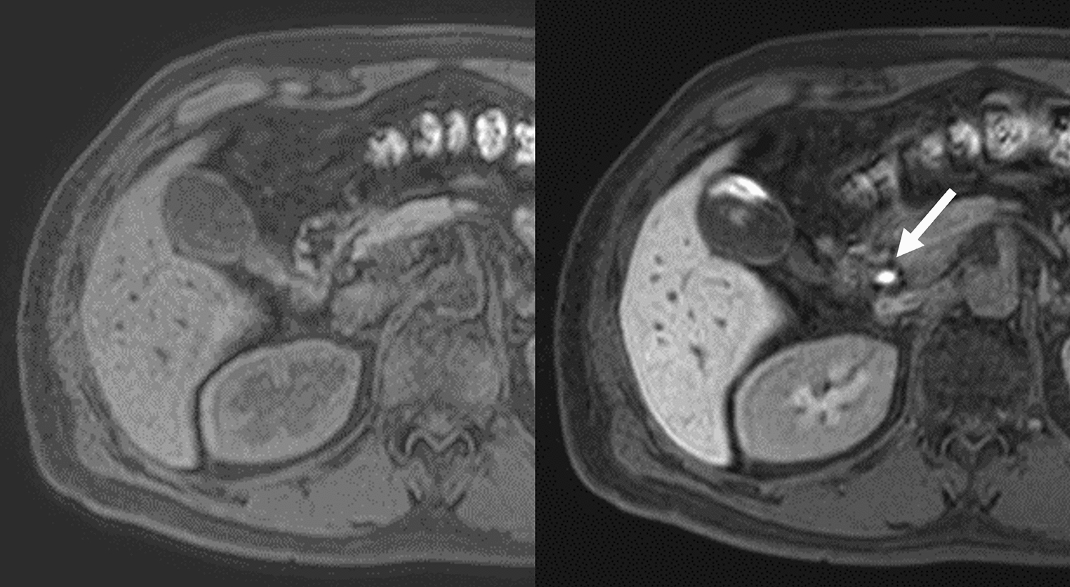 Can bile excretion on Gd-EOB-MRI be used as a visual criterion for the hepatobiliary phase?