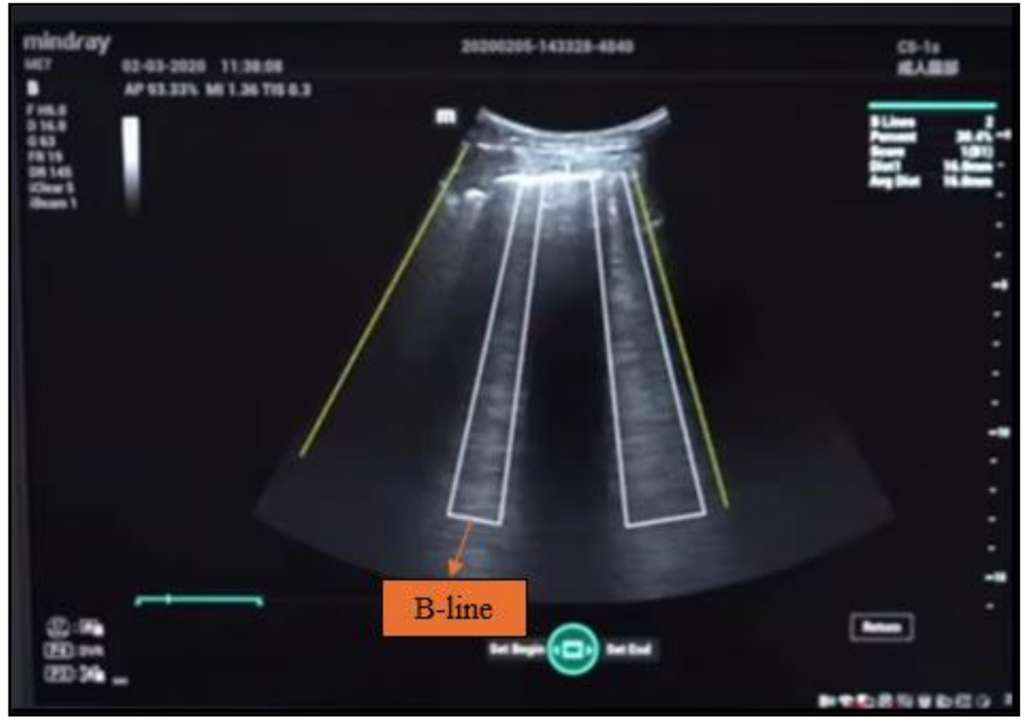 Automatic B-lines: a tool for minimizing time to diuretic administration in pulmonary edema patients in the emergency department of a developing country