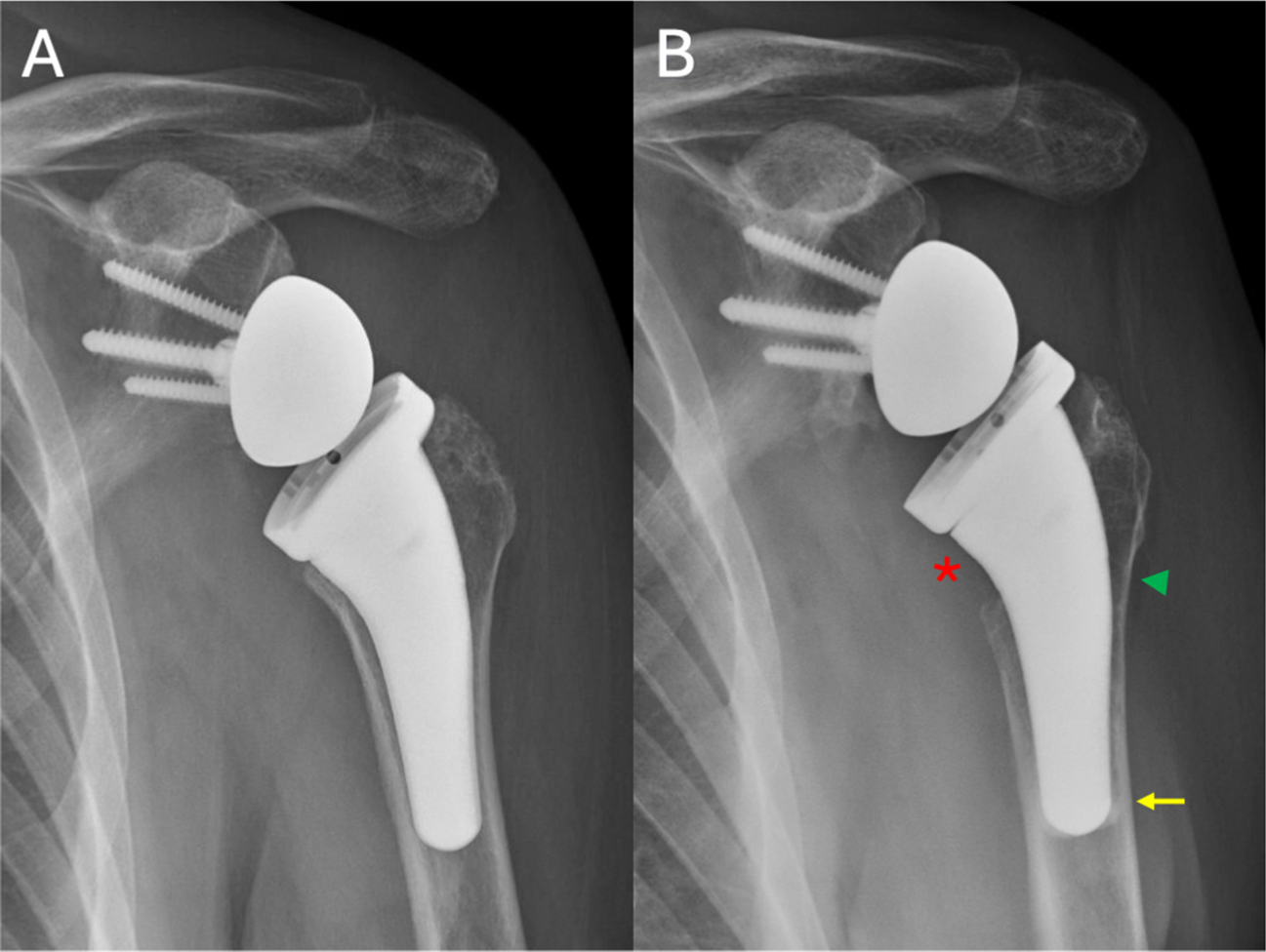 Humeral Stem Design in Reverse Total Shoulder Arthroplasty