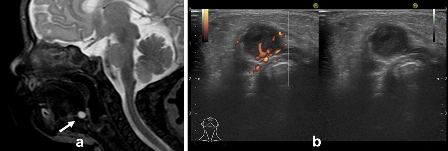 Be familiar with benign pediatric head and neck lesions! Image interpretation guides to overcome your weakness