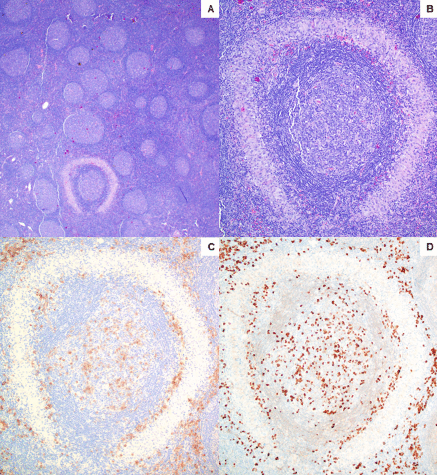 Perifollicular concentric granulomas: A clue to IgG4-related lymphadenopathy