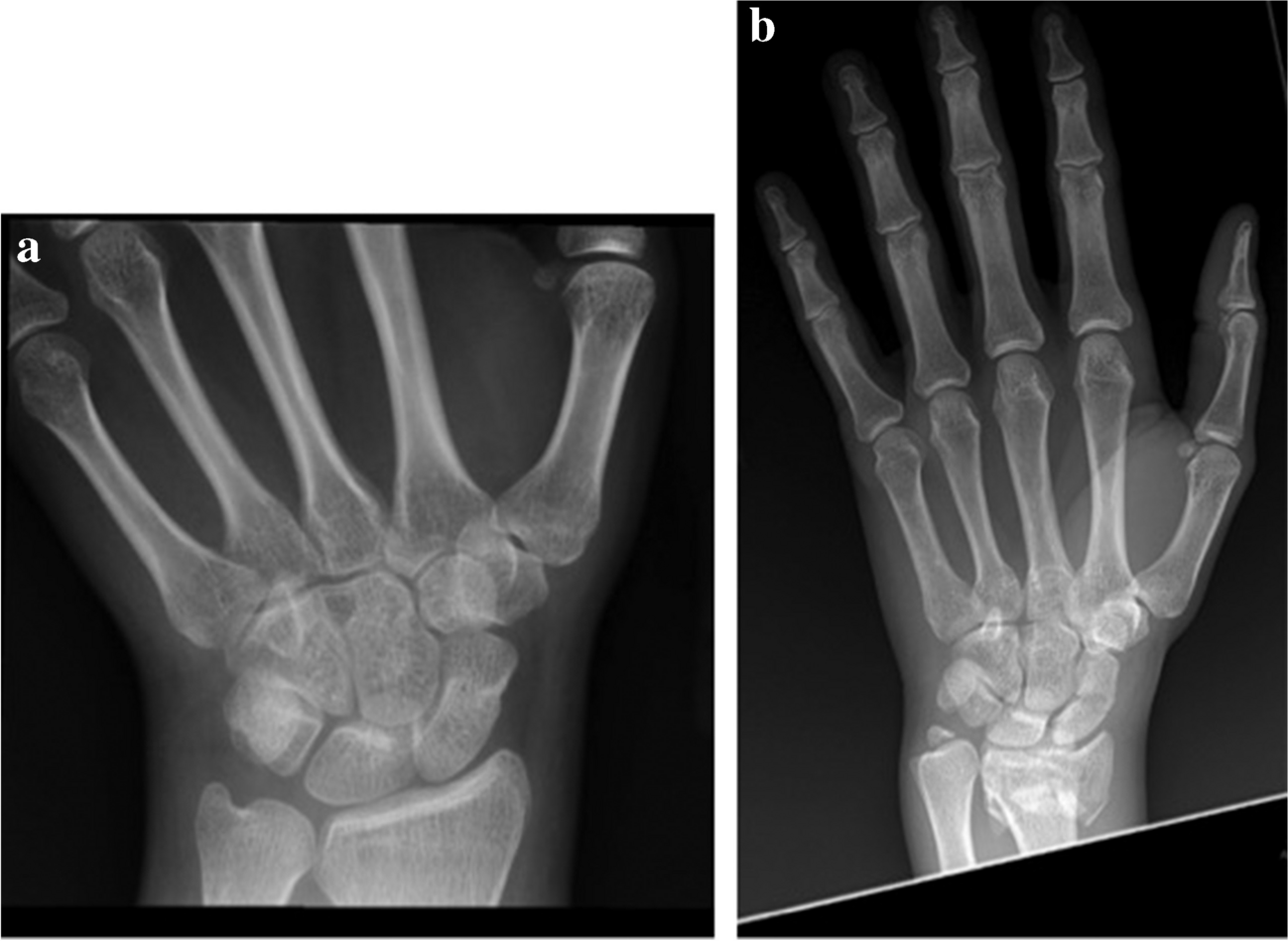 Treatment Options, Return to Play, and Functional Performance after Operatively and Non-operatively Managed Acute Scaphoid Fractures