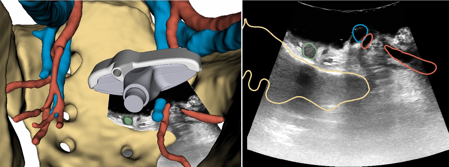 Real-time intraoperative ultrasound registration for accurate surgical navigation in patients with pelvic malignancies