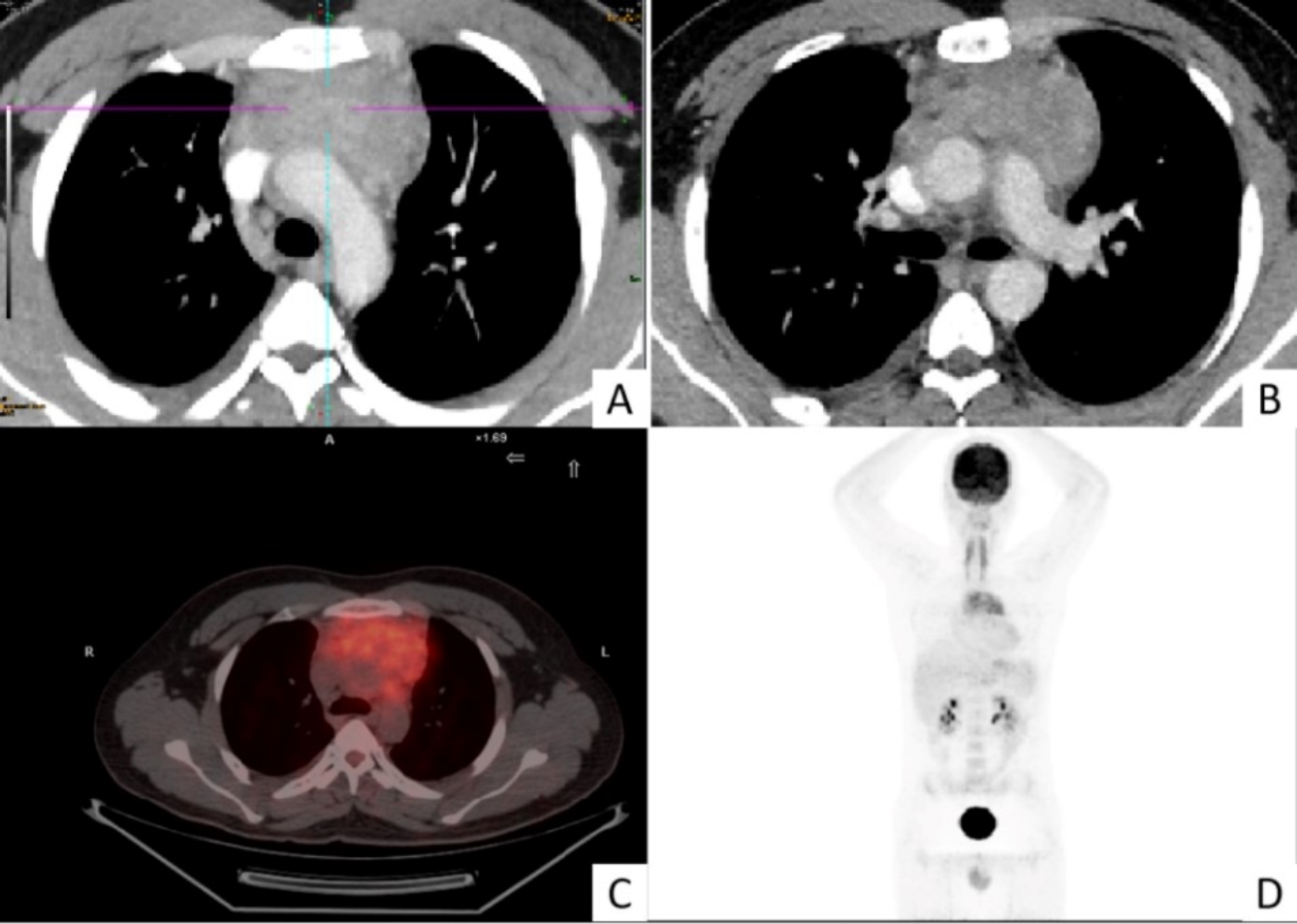 Extranodal Rosai-Dorfman disease masquerading as intrathoracic invasive malignancy with ankylosing spondylitis: a case report