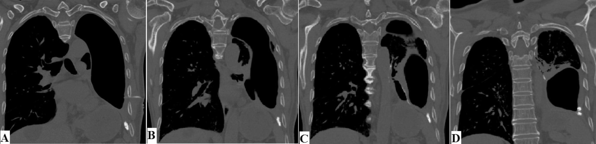 Application of pedicle combined muscle flaps in treatment of chronic empyema with huge irregular abscess cavity after pulmonary surgery: a case report and literature review