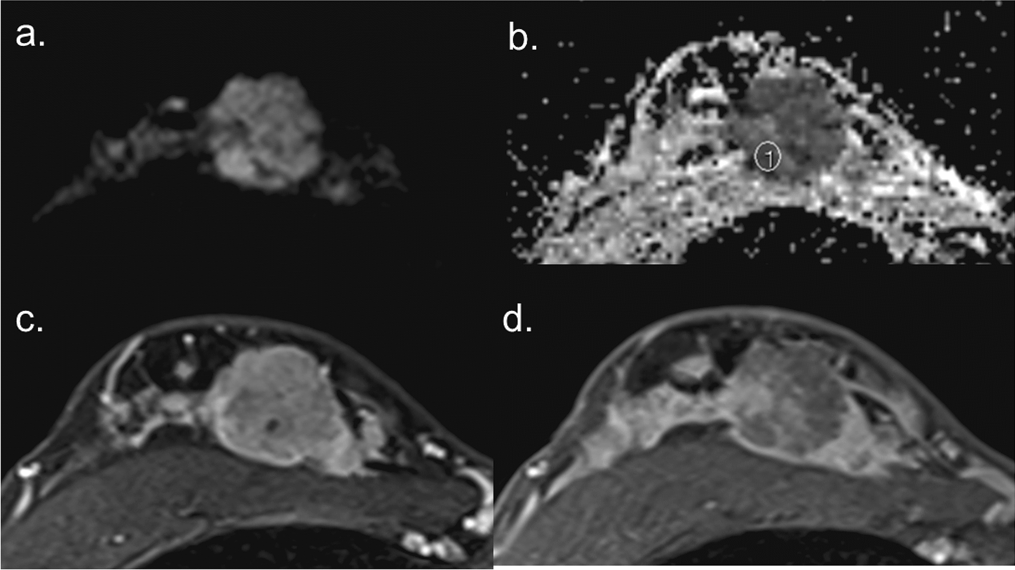 Standardization and advancements efforts in breast diffusion-weighted imaging