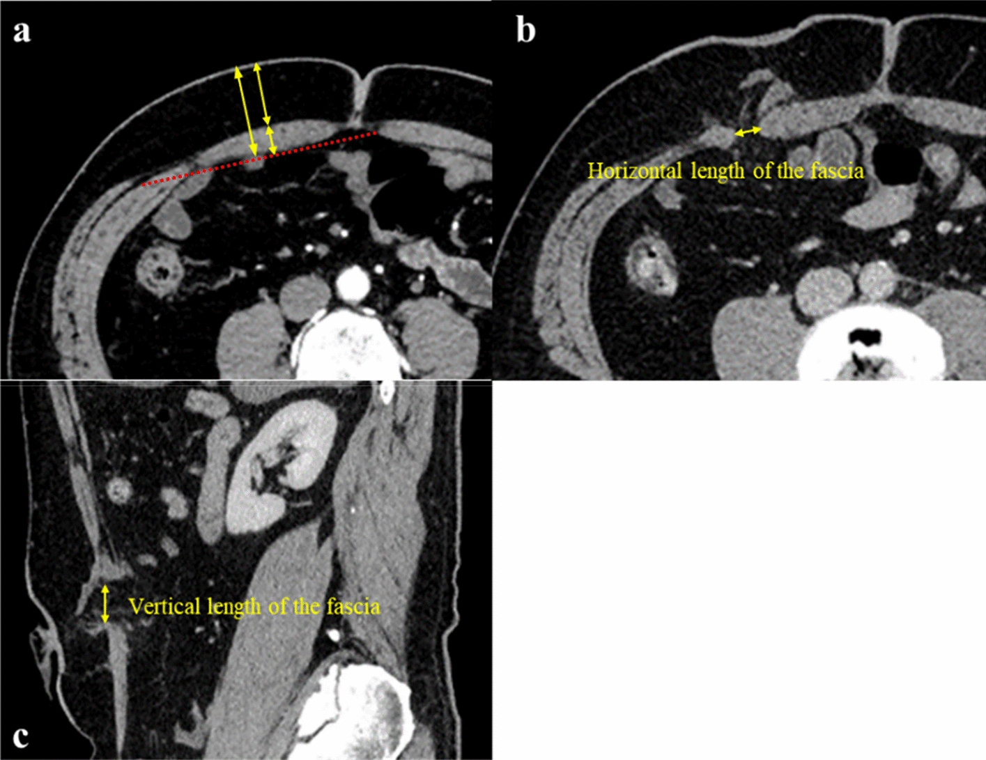 A novel technique for the construction of an end ileostomy to prevent stoma outlet obstruction after rectal resection and total colectomy: a single-center retrospective study