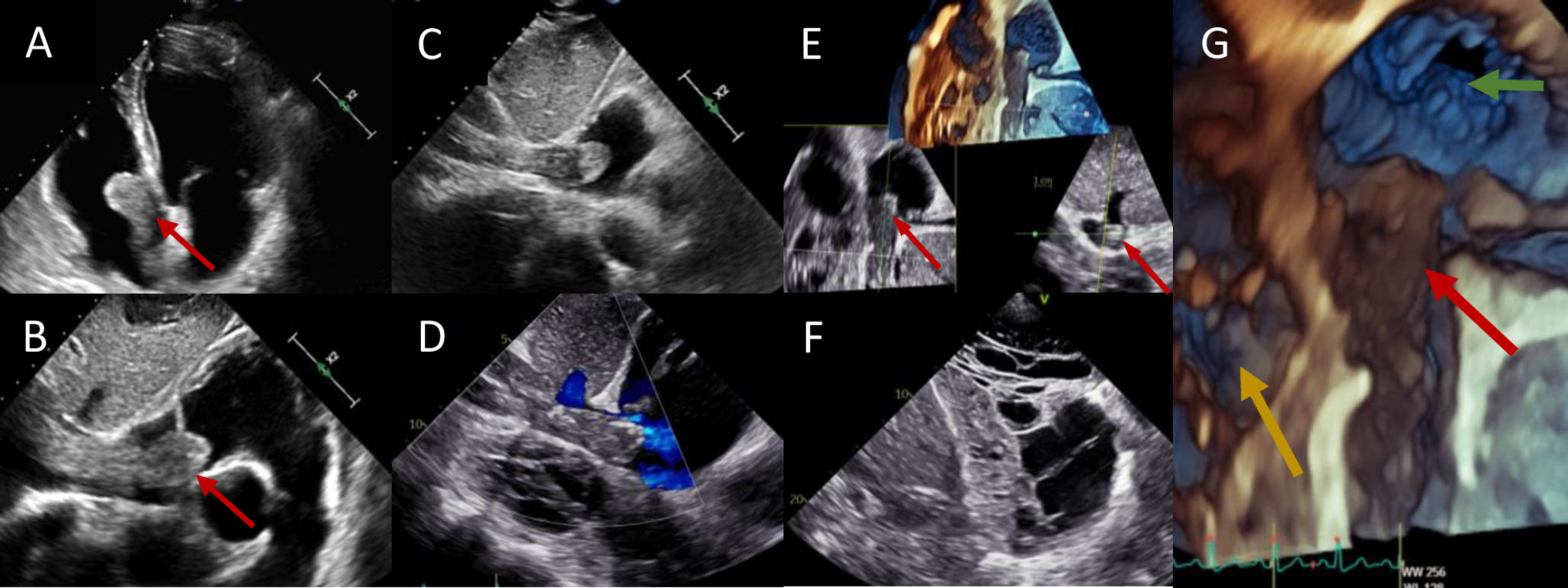 Renal cell carcinoma tumor bulk extending to inferior vena cava and right atrium