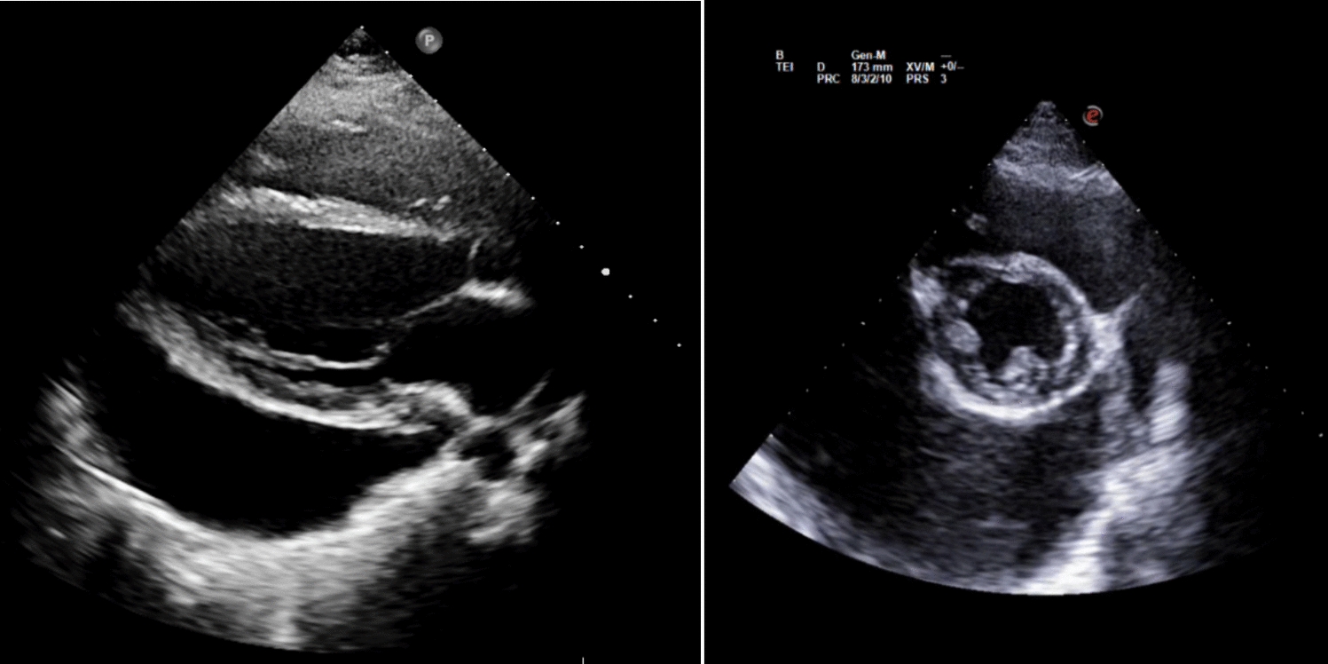 What is your next step? A case of large pericardial effusion during pregnancy