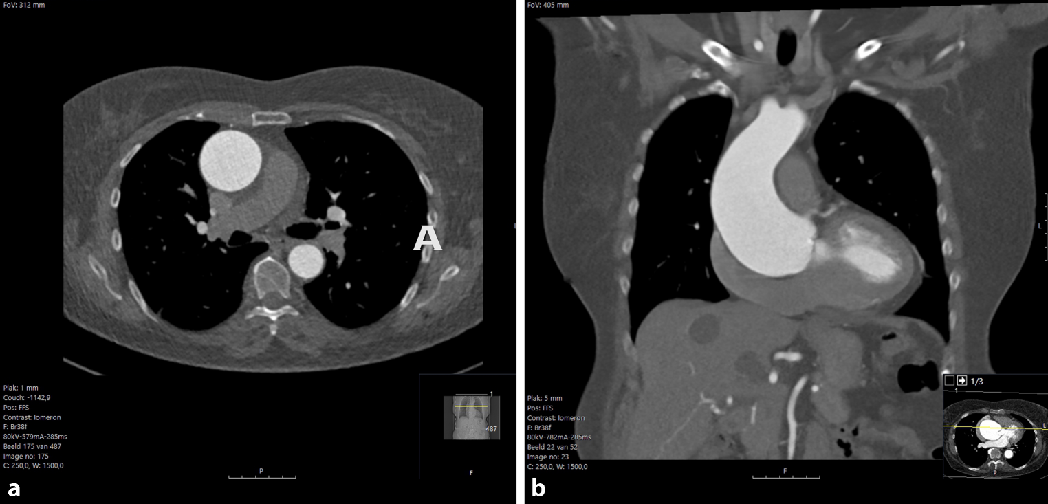 Sudden onset chest pain after a CT-scan of the aorta