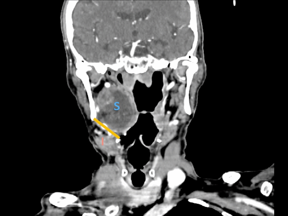 Embracing the Transoral Parapharyngeal Space Surgery (TOPPSS)