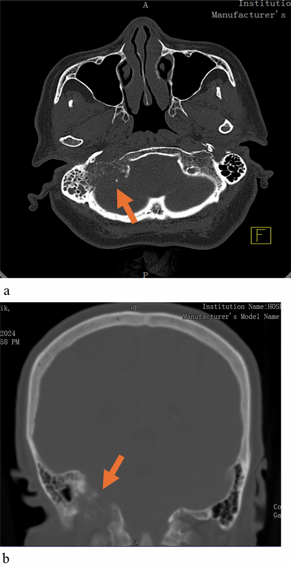 An Exceptional Case of Garcin Syndrome Mimicking Bell’s Palsy in Advanced Non-Small Cell Lung Carcinoma