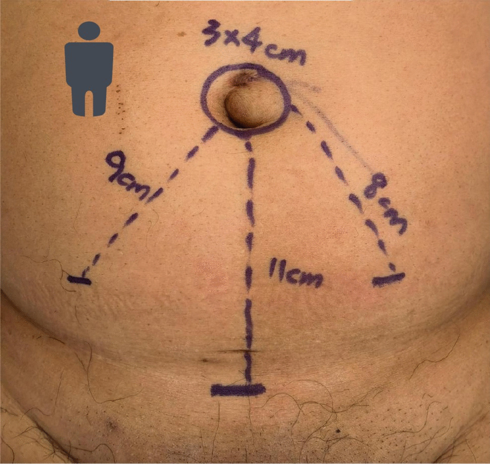 A Novel Method of Endoscopic Access to Establish Preperitoneal Space for Ventral Hernia with Optical Gasless Trocar