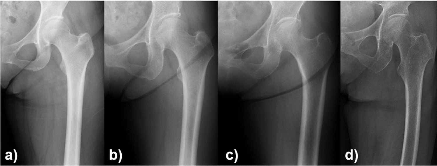 Osteoporosis screening using X-ray assessment and osteoporosis self-assessment tool for Asians in hip surgery patients