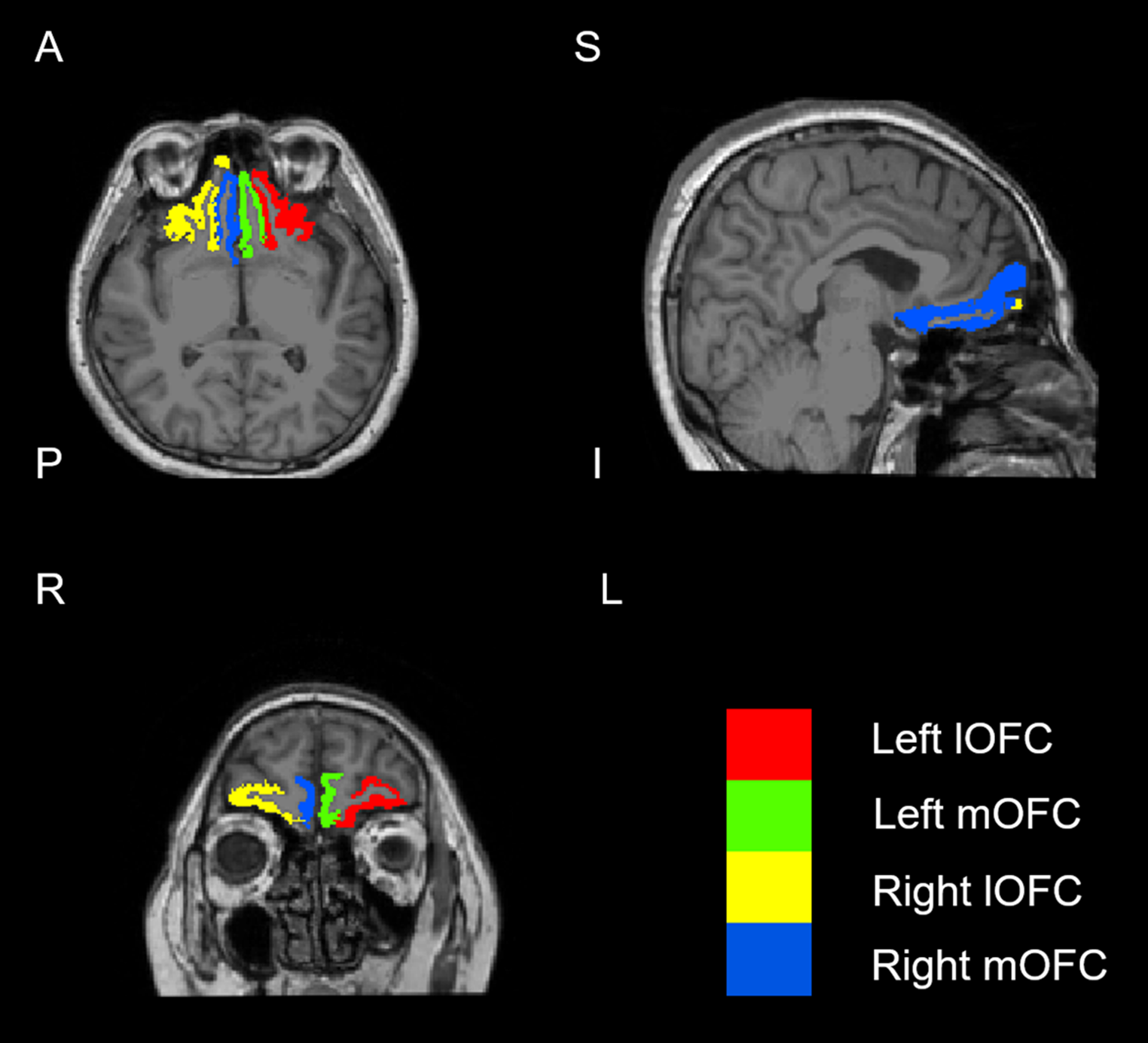 The study on agitation and structure of orbitofrontal cortex subregion in first-episode drug-naïve patients with schizophrenia