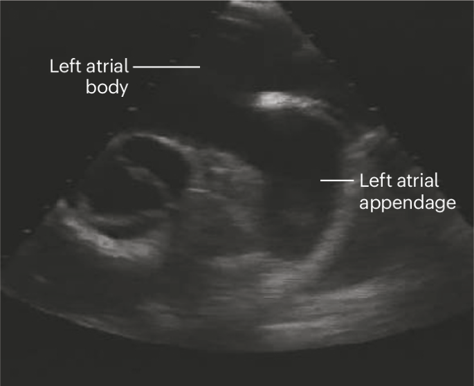 Left atrial appendage closure after ablation: the best OPTION for patients with AF?