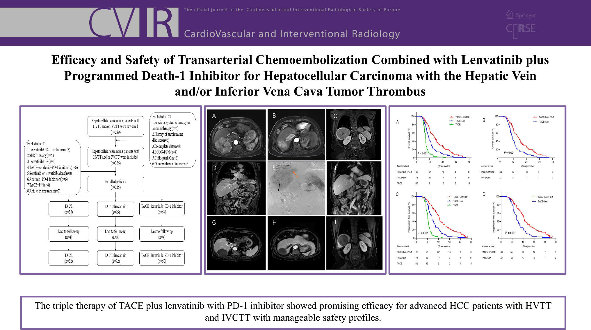 Efficacy and Safety of Transarterial Chemoembolization Combined with Lenvatinib Plus Programmed Death-1 Inhibitor for Hepatocellular Carcinoma with the Hepatic Vein and/or Inferior Vena Cava Tumor Thrombus