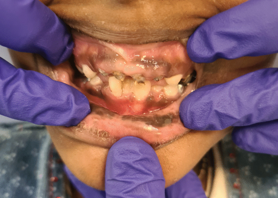 Clinical and molecular profile of 20 patients with DOCK8 deficiency—a single-center experience from Southern India