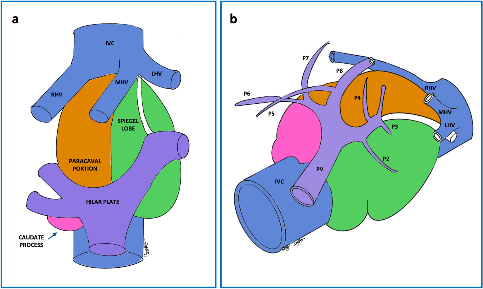 Complete hepatic caudate lobe resection: is robotic approach safe? Report from experienced centers