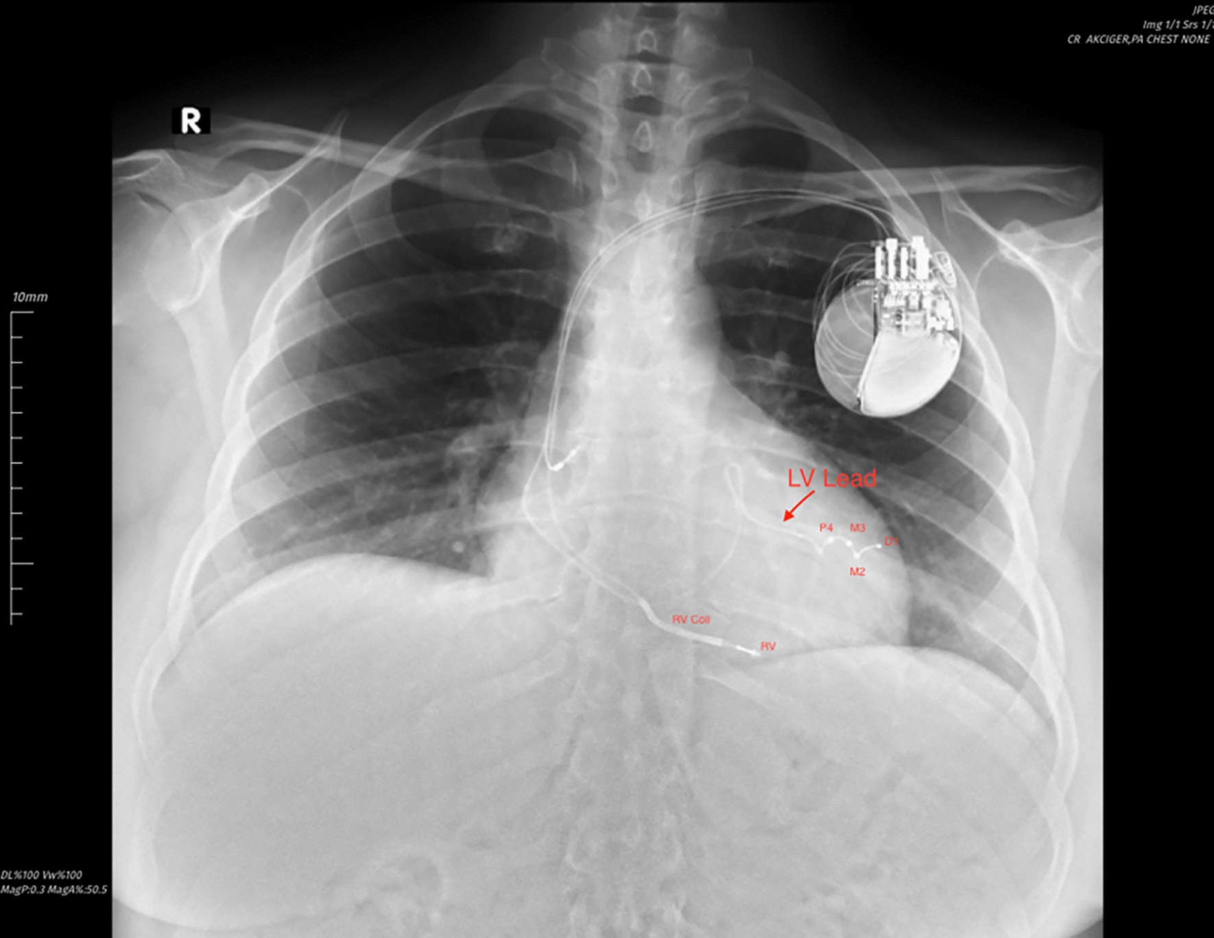 Intraoperative diaphragmatic stimulation by a cardiac resynchronization therapy defibrillator presenting as hiccups