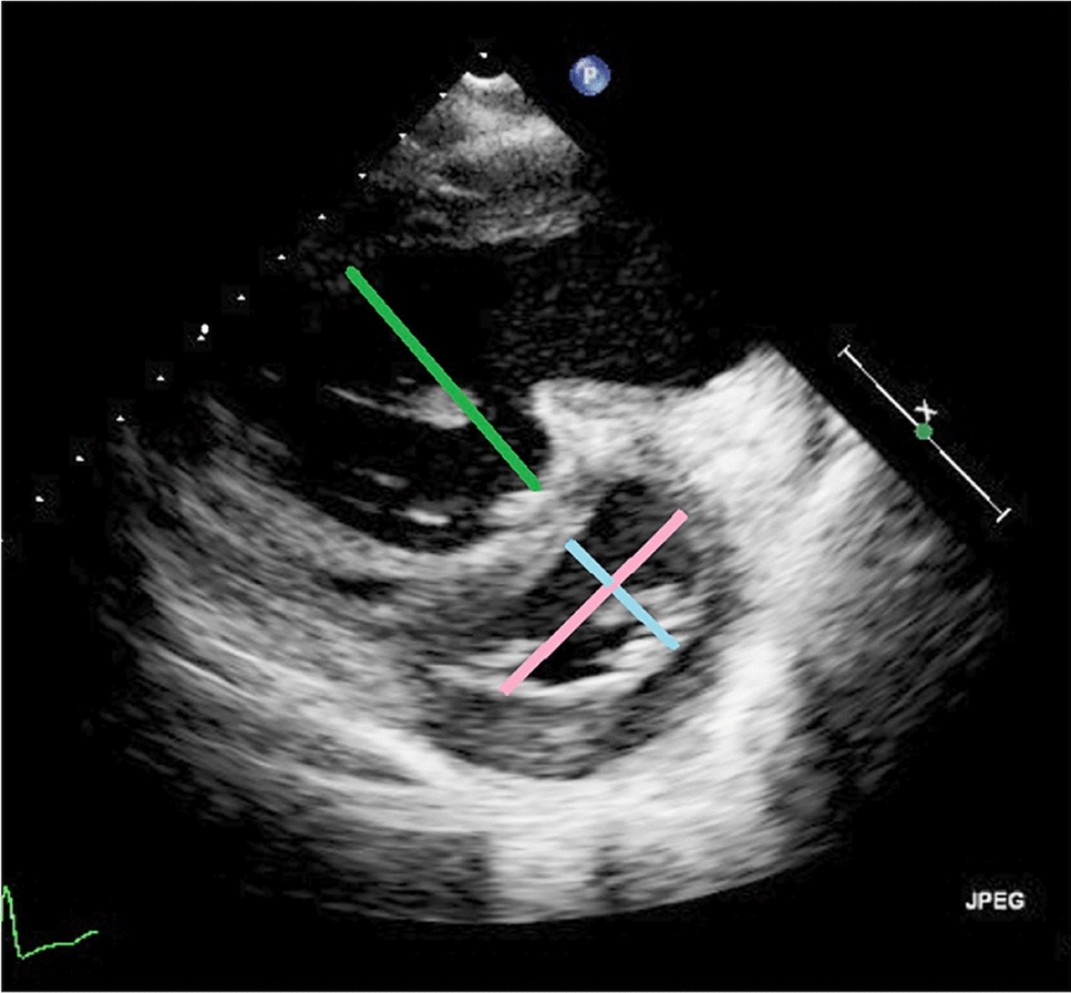 Echocardiographic Changes in Infants with Severe Congenital Diaphragmatic Hernia After Fetoscopic Endoluminal Tracheal Occlusion (FETO)