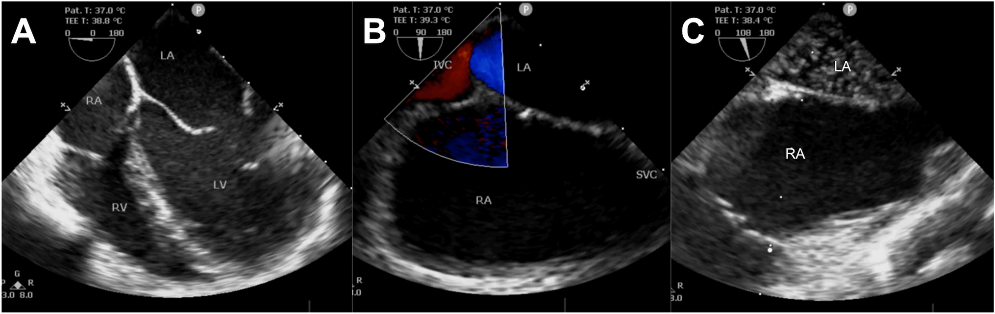 Iatrogenic Post-Surgical Cyanosis Due to Vena Caval Redirection to the Left Atrium and Its Transcatheter Management