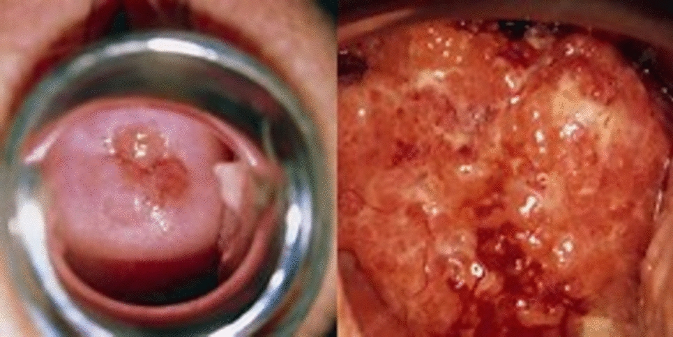 Serous Carcinoma of Uterine Cervix: A Clinicopathological Dilemma