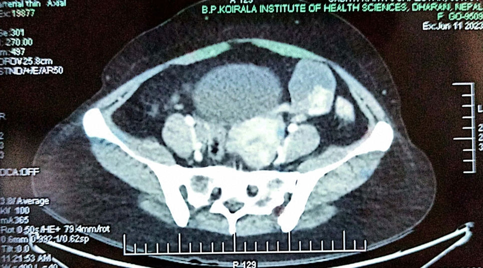 Ovarian Struma Carcinoid: A Rare Case Report