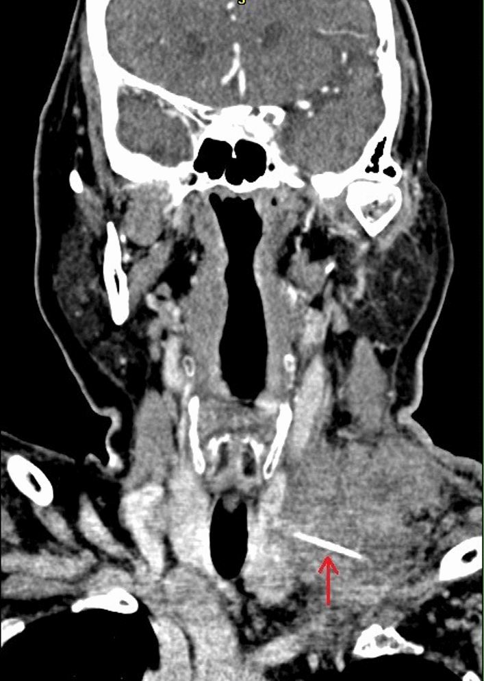 The Lingering Threat: A Migratory Fish Bone Causing Delayed Cervical Foreign Body Granuloma