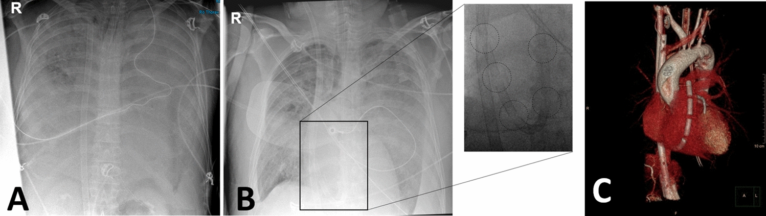 Total reversal of the pulmonary circulation (RPC) induced by peripheral cannulation for veno-arterial ECMO in a patient with aortic and mitral valve insufficiency: a case report