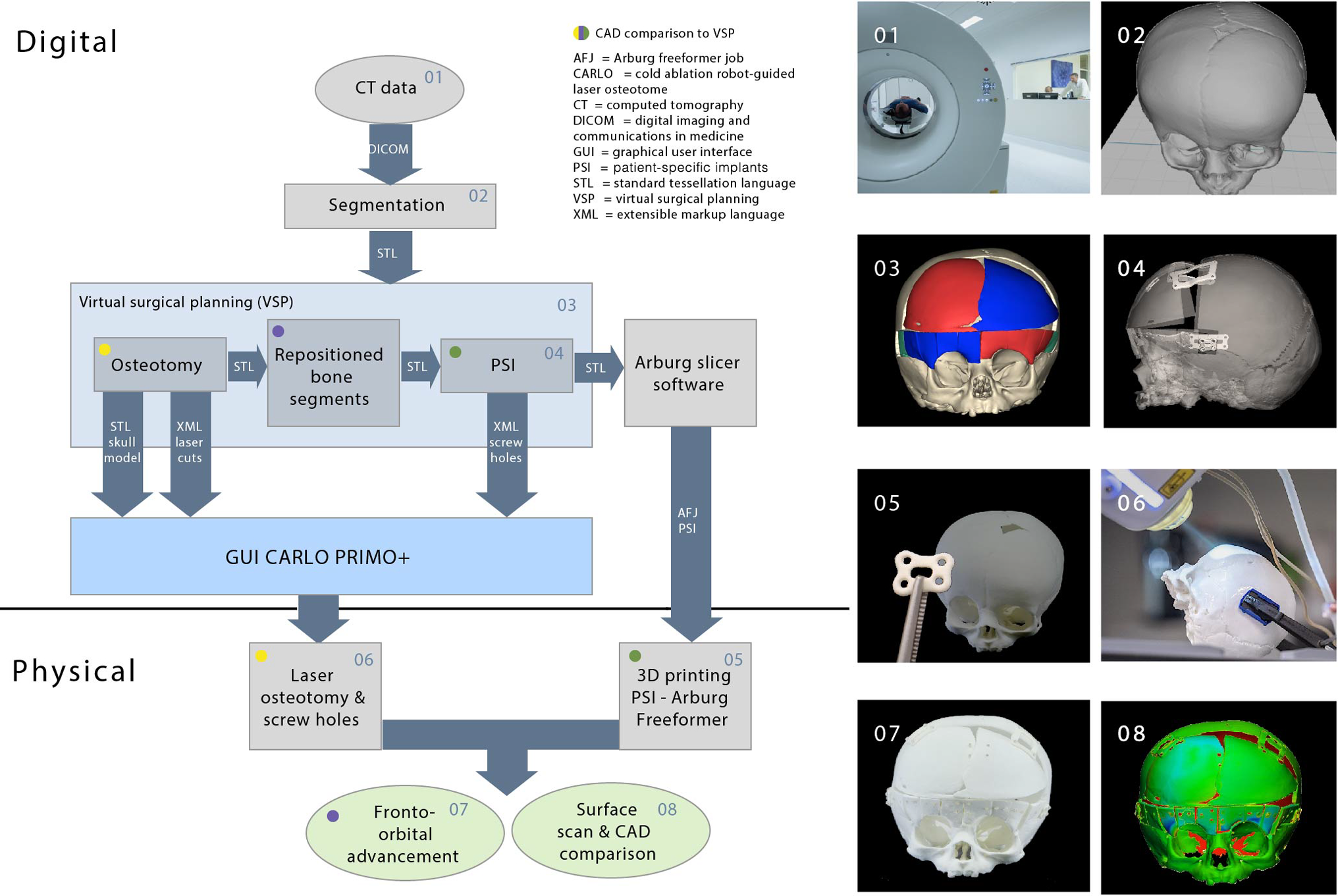 Fronto-orbital advancement with patient-specific 3D-printed implants and robot-guided laser osteotomy: an in vitro accuracy assessment