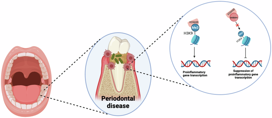 Synthesis, characterization, and evaluation of KDM4B inhibitors to attenuate inflammatory host immune response in periodontitis