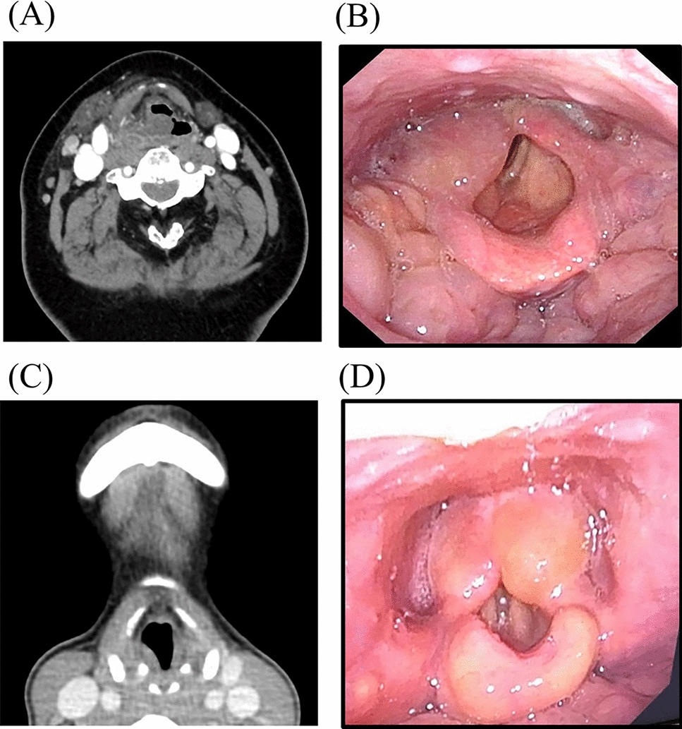 Predictive factors in difficult postoperative airway management of severe odontogenic deep neck infection