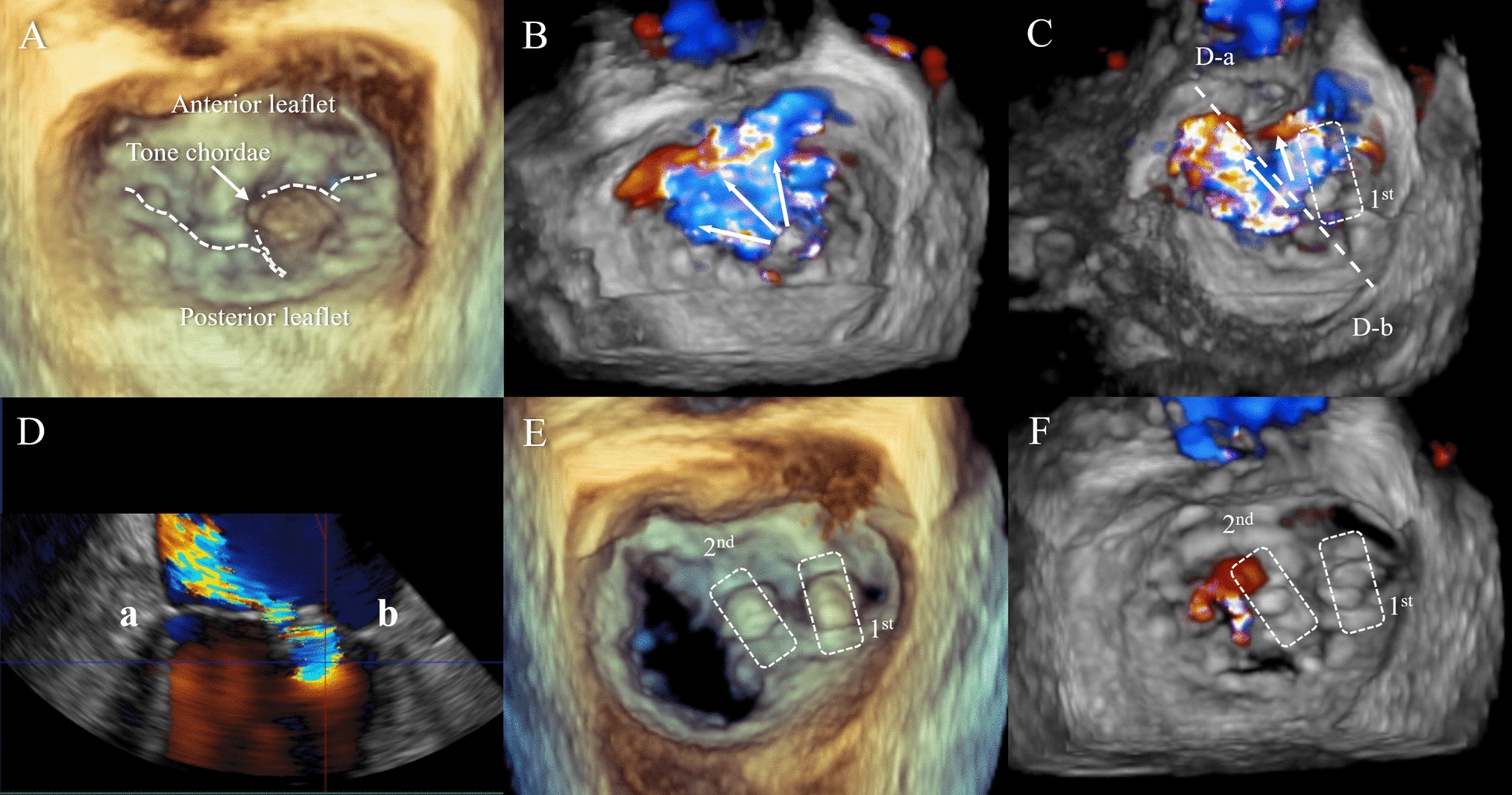 Successful transcatheter edge-to-edge repair with PASCAL devices in a patient with large prolapse and deep cleft