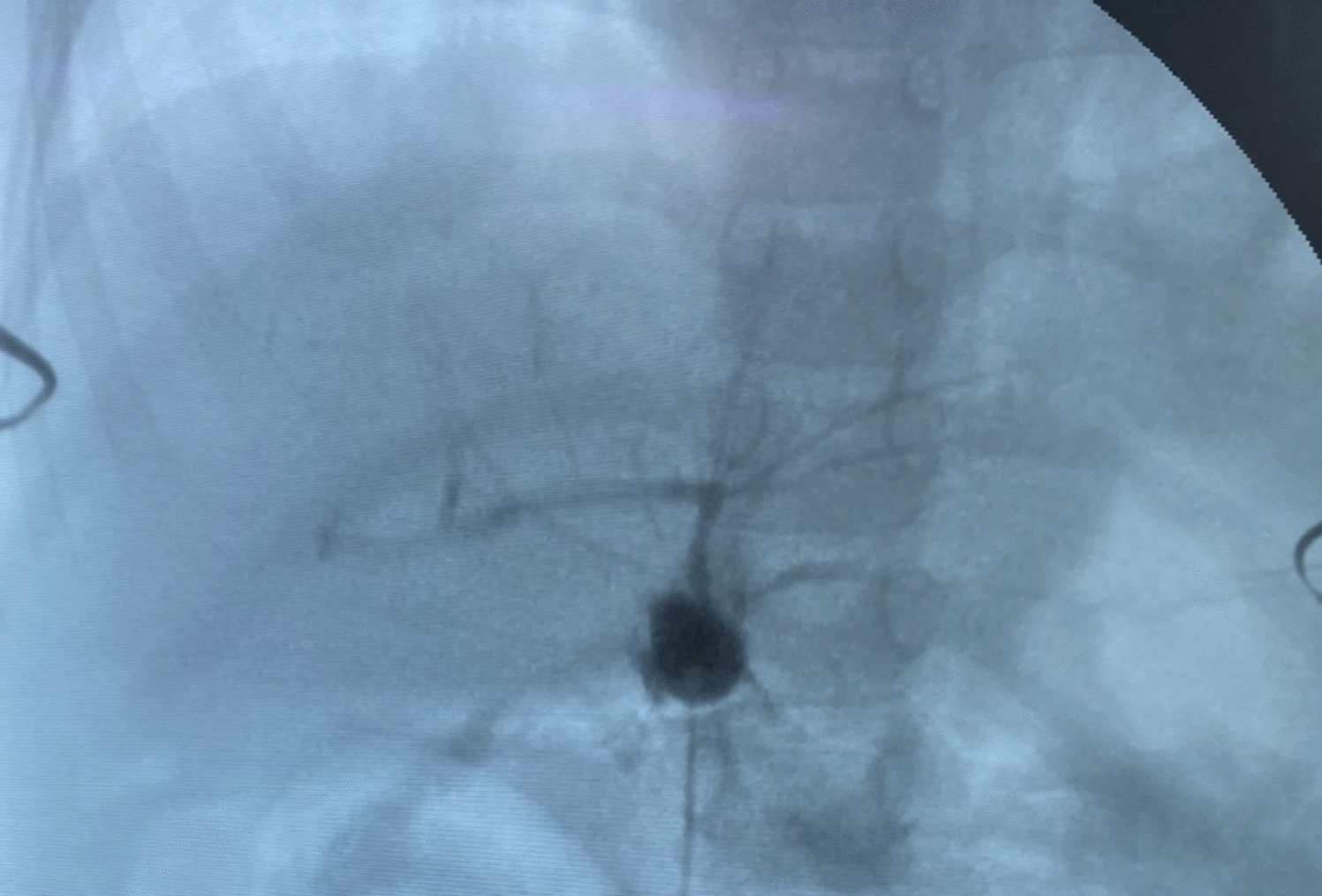 The effectiveness of alternative vessel grafts for meso-rex bypass in the treatment of extrahepatic portal vein obstruction in children