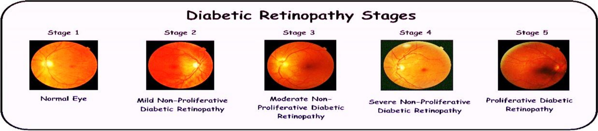 Enhancing diabetic retinopathy and macular edema detection through multi scale feature fusion using deep learning model