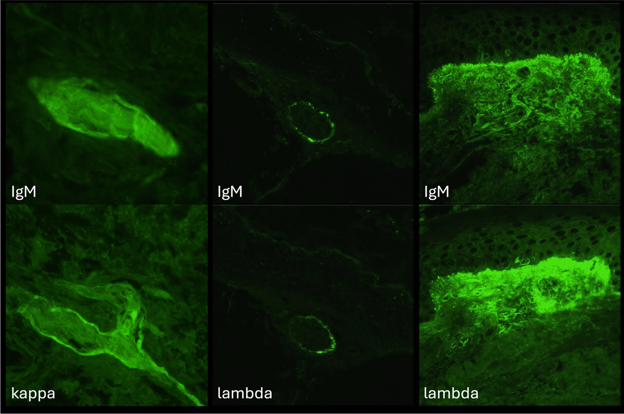 Monoclonal Gammopathy-Associated Neuropathy