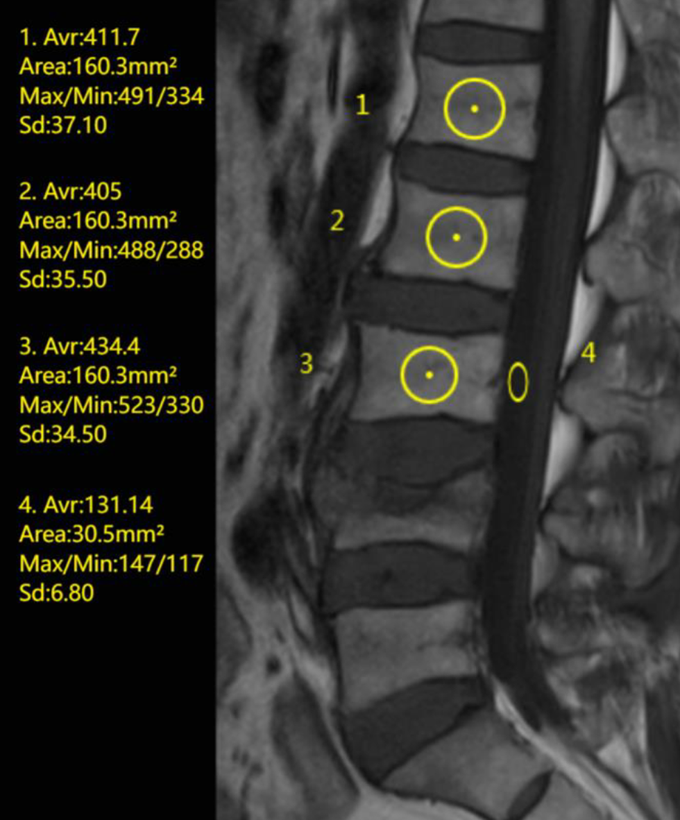 Association between vertebral bone quality score and residual back pain following percutaneous vertebroplasty for osteoporotic vertebral compression fractures