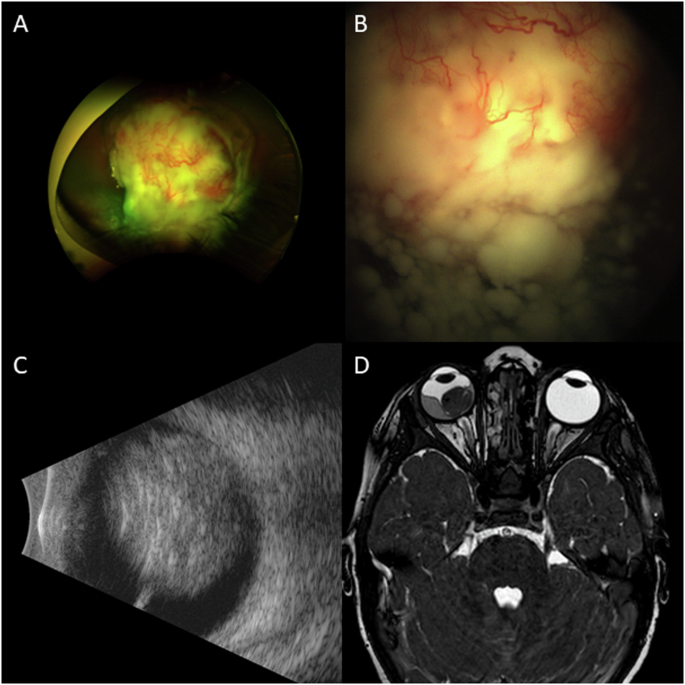 Retinoblastoma vitreous seeding underestimation on ophthalmoscopy