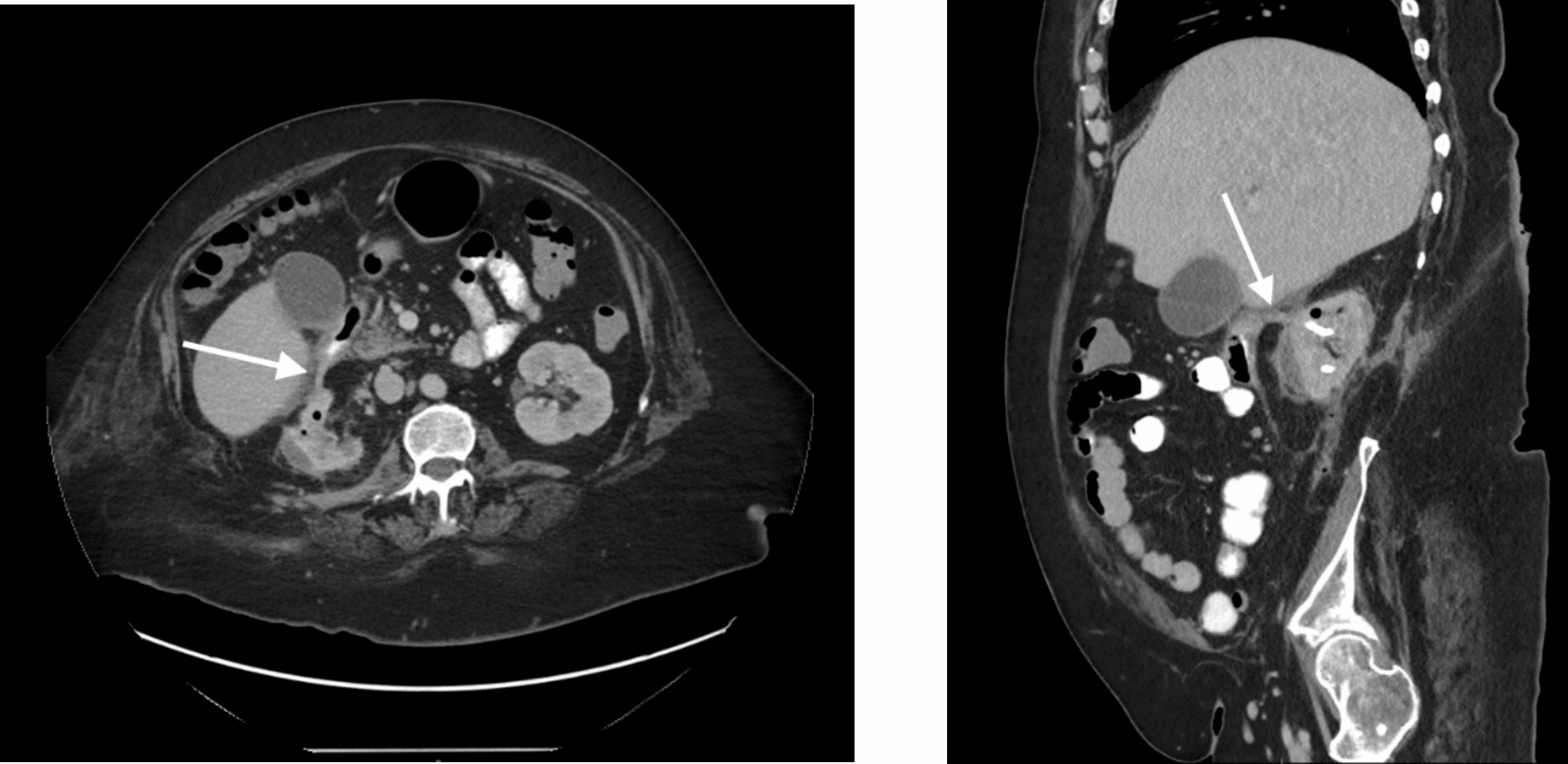 Pyeloduodenal fistula: a review of the current literature