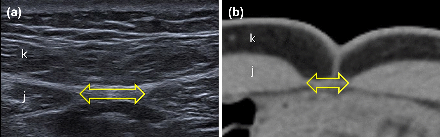 Differential linea alba width in pediatric umbilical hernias: a comparative analysis