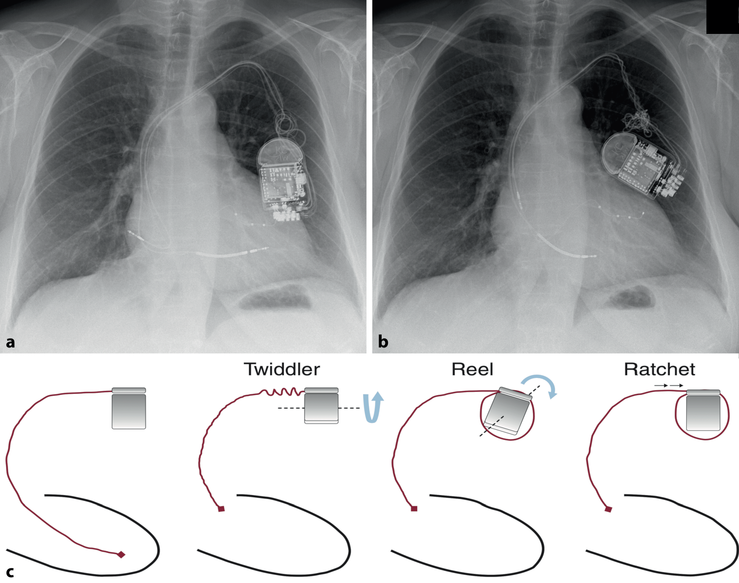 Twists and turns: CRT-D with mixed Twiddler and Reel syndromes