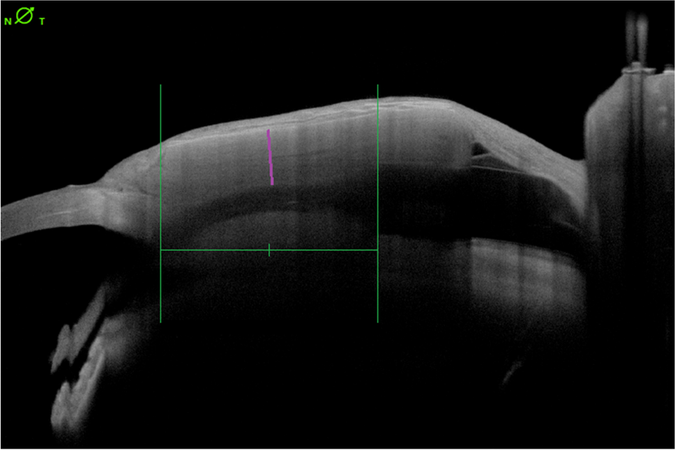 Anterior segment OCT for imaging PAUL® glaucoma implant patch grafts: a useful method for follow-up and risk management